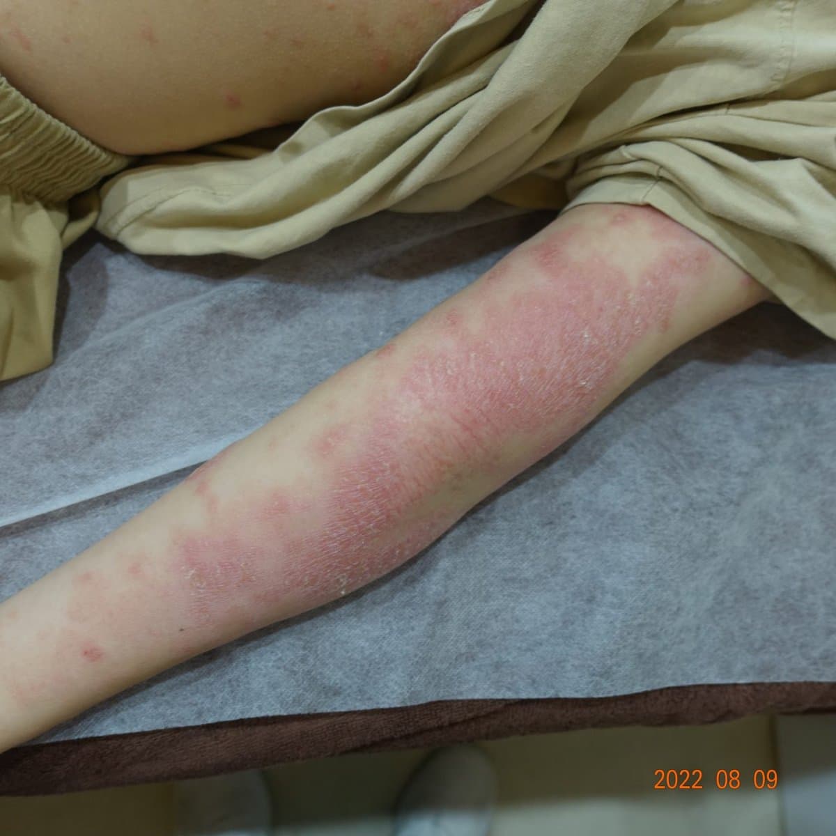 건선 치료 전 증상 팔 부위