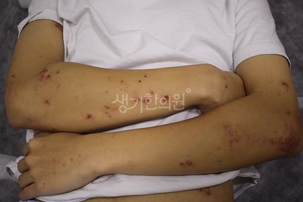 결절성양진 치료 전 사진 — 안산점, 팔,다리(손, 발), 10대 남, 치료 기간 4개월 치료전