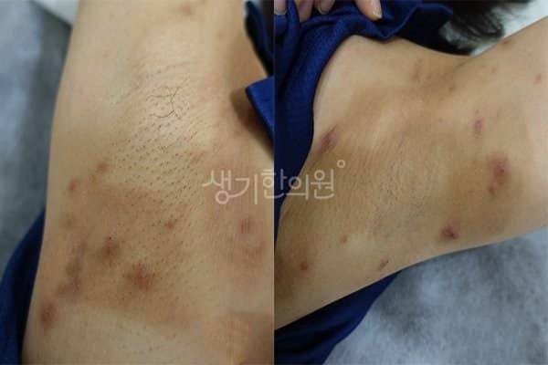 결절성양진 치료 전 사진 — 광주점, 기타, 40대 여, 치료 기간 4개월 치료전