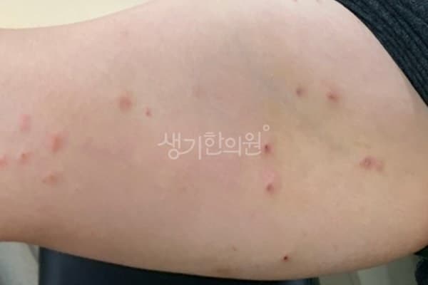 결절성양진 치료 전 사진 — 신도림점, 팔,다리(손, 발), 40대 여, 치료 기간 6개월 치료전
