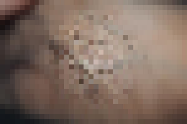 곤지름 치료 전 사진 — 천안아산점, 기타, 20대 남, 치료 기간 4개월 치료전 (모자이크 처리)