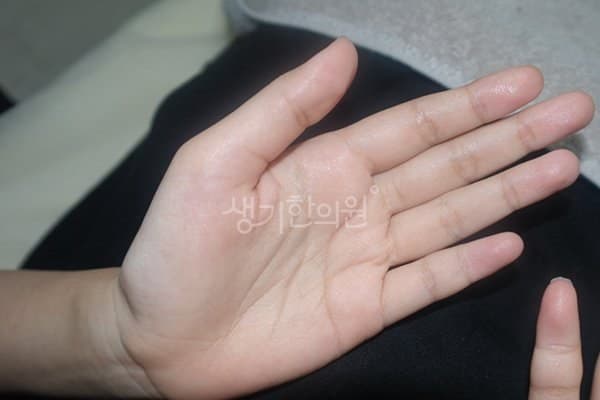 다한증 치료 전 사진 — 천안아산점, 팔,다리(손, 발), 10대 여, 치료 기간 2개월 치료전