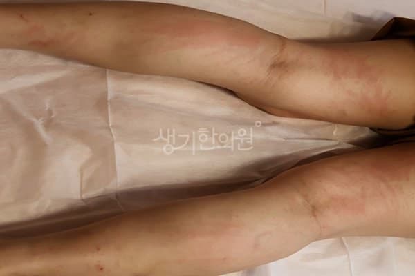 두드러기 치료 전 사진 — 분당점, 팔,다리(손, 발), 40대 여, 치료 기간 3개월 치료전