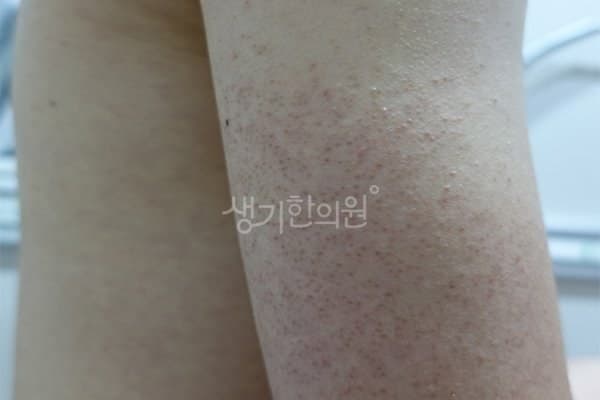 모공각화증 치료 전 사진 — 광주점, 팔,다리(손, 발), 20대 남, 치료 기간 5개월 치료전