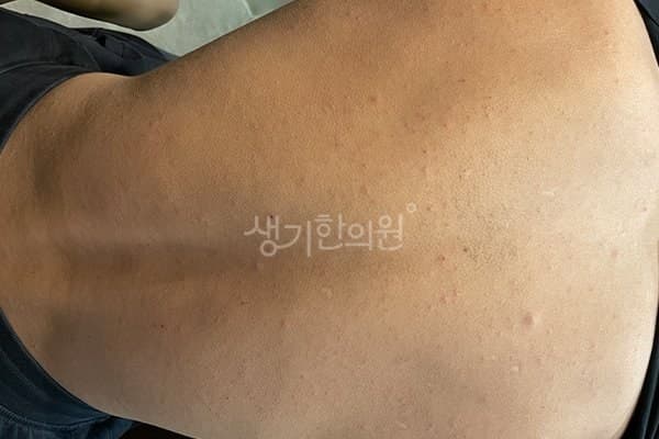 모공각화증 치료 전 사진 — 잠실점, 기타, 10대 남, 치료 기간 9개월 치료전