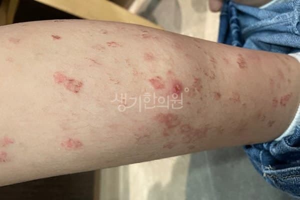 모공각화증 치료 전 사진 — 잠실점, 팔,다리(손, 발), 10대 여, 치료 기간 3개월 치료전