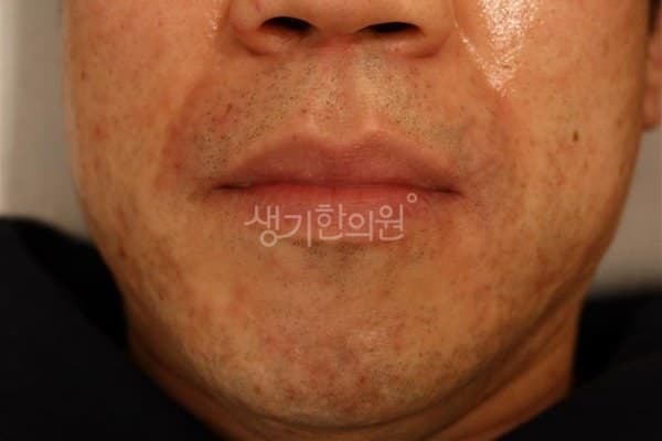 모낭염 치료 전 사진 — 대구점, 얼굴, 40대 남, 치료 기간 14개월 치료전