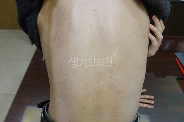 모낭염 치료 전 사진 — 광주점, 기타, 20대 남, 치료 기간 3개월 치료전