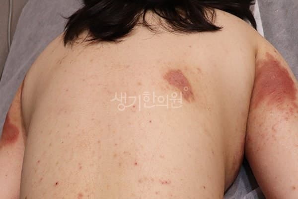 백선 치료 전 사진 — 수원점, 전신, 20대 여, 치료 기간 5개월 치료전