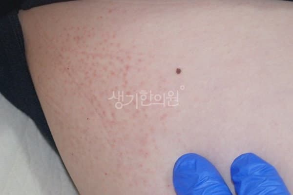 백선 치료 전 사진 — 천안아산점, 기타, 30대 여, 치료 기간 3개월 치료전