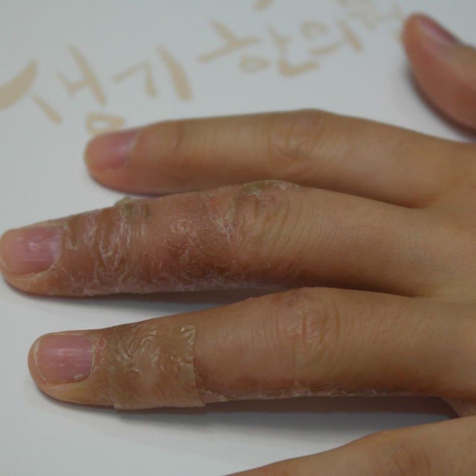 습진 치료 전 증상 손등 부위