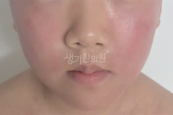 안면홍조 치료 전 사진 — 창원점, 얼굴, 10대 남, 치료 기간 5개월 치료전