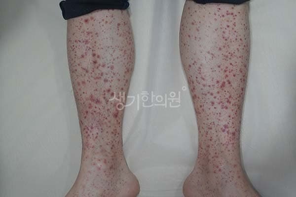 자반증 치료 전 사진 — 천안아산점, 팔,다리(손, 발), 40대 남, 치료 기간 3개월 치료전