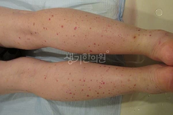 자반증 치료 전 사진 — 부산서면점, 팔,다리(손, 발), 60대 이상 여, 치료 기간 3개월 치료전