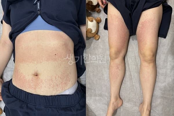 자반증 치료 전 사진 — 부천점, 팔,다리(손, 발), 40대 여, 치료 기간 3개월 치료전