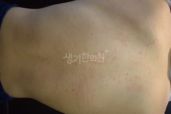 장미색비강진 치료 전 사진 — 잠실점, 기타, 10대 남, 치료 기간 3개월 치료전
