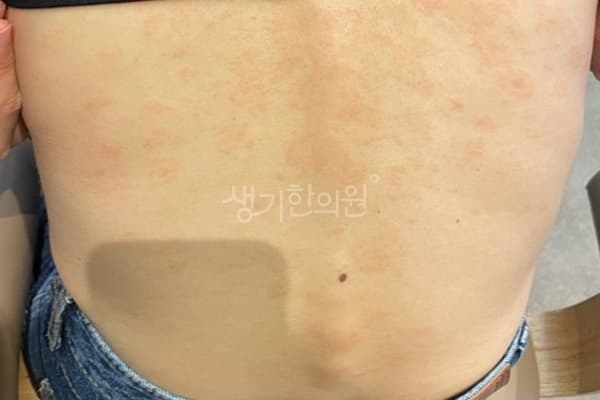 장미색비강진 치료 전 사진 — 잠실점, 기타, 30대 여, 치료 기간 3개월 치료전