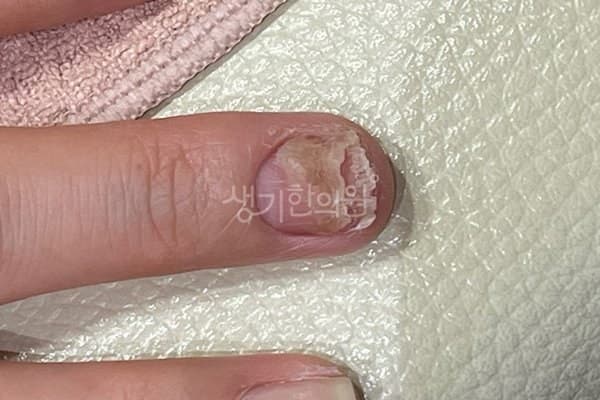 조갑박리증 치료 전 사진 — 잠실점, 팔,다리(손, 발), 40대 여, 치료 기간 8개월 치료전