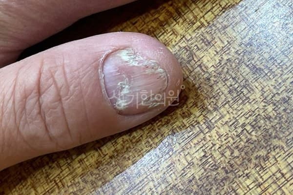 조갑박리증 치료 전 사진 — 잠실점, 팔,다리(손, 발), 40대 남, 치료 기간 6개월 치료전