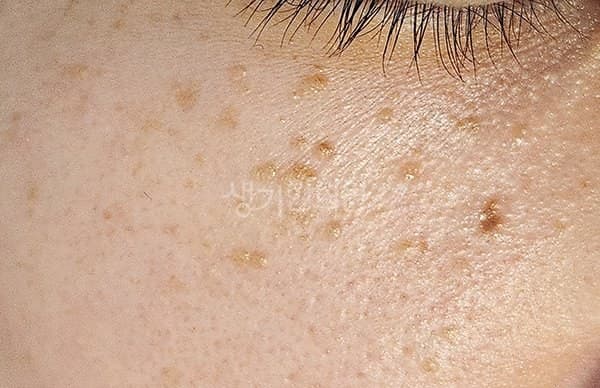 편평사마귀 치료 전 사진 — 대전점, 얼굴, 40대 여, 치료 기간 3개월 치료전