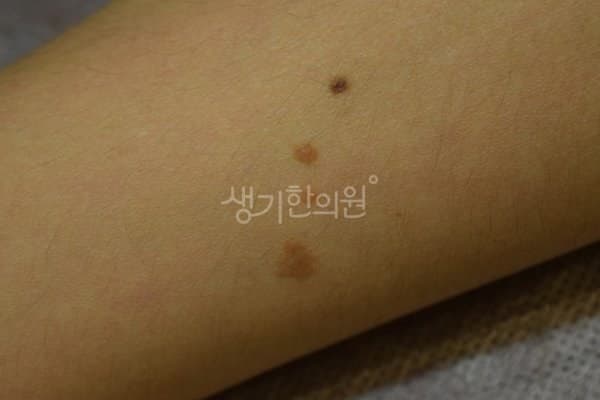 편평사마귀 치료 전 사진 — 잠실점, 팔,다리(손, 발), 20대 남, 치료 기간 7개월 치료전
