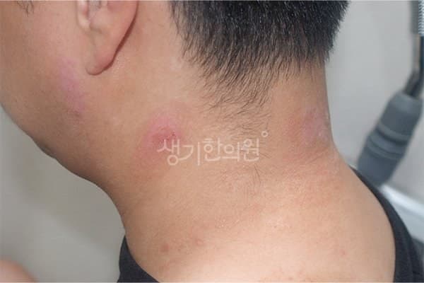 햇빛알레르기 치료 전 사진 — 천안아산점, 얼굴, 30대 남, 치료 기간 2개월 치료전