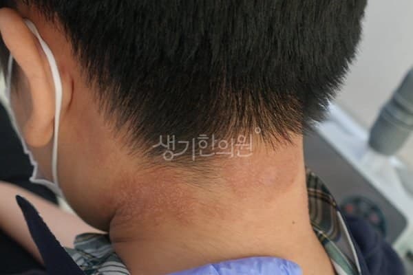 햇빛알레르기 치료 전 사진 — 천안아산점, 얼굴, 10대 남, 치료 기간 4개월 치료전
