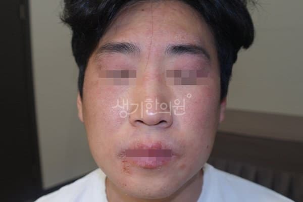 햇빛알레르기 치료 전 사진 — 천안아산점, 얼굴, 30대 남, 치료 기간 3개월 치료전