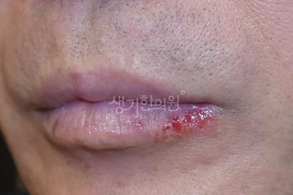 헤르페스 치료 전 사진 — 천안아산점, 기타, 60대 이상 남, 치료 기간 3개월 치료전