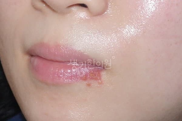 헤르페스 치료 전 사진 — 천안아산점, 기타, 30대 여, 치료 기간 3개월 치료전