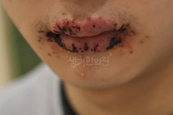 헤르페스 치료 전 사진 — 분당점, 얼굴, 10대 남, 치료 기간 2개월 치료전