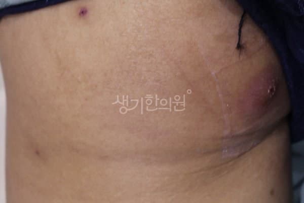 화농성한선염 치료 전 사진 — 인천점, 기타, 30대 남, 치료 기간 4개월 치료전