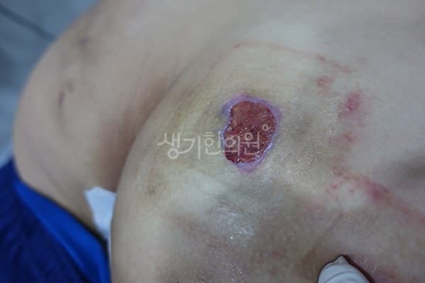 화농성한선염 치료 전 사진 — 광주점, 기타, 20대 남, 치료 기간 8개월 치료전