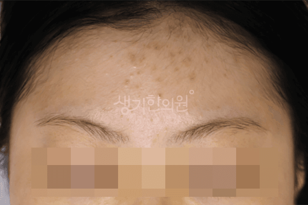 여드름 치료 전 사진 — 안산점, 치료 기간 5개월