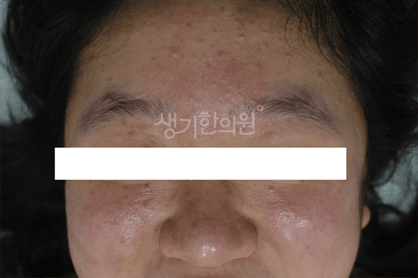 여드름 치료 전 사진 — 부천점, 치료 기간 2개월