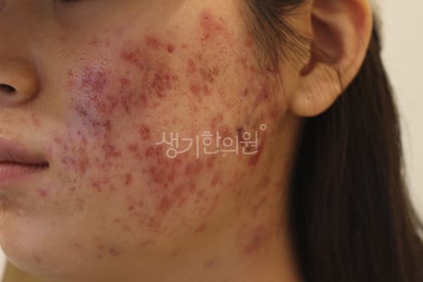 여드름 치료 전 사진 — 부산서면점, 치료 기간 5개월