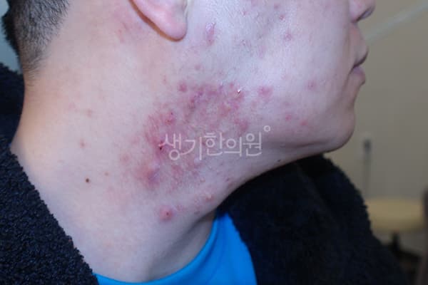 여드름 치료 전 사진 — 천안아산점, 치료 기간 5개월