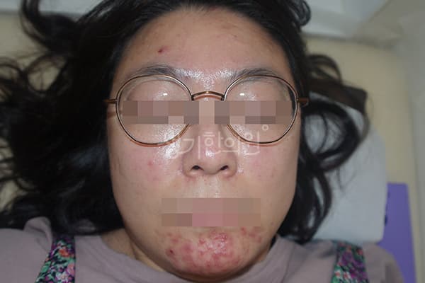 여드름 치료 전 사진 — 천안아산점, 치료 기간 4개월