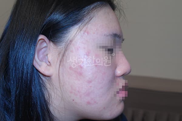여드름 치료 전 사진 — 천안아산점, 치료 기간 3개월