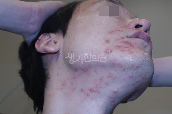 여드름 치료 전 사진 — 천안아산점, 치료 기간 5개월