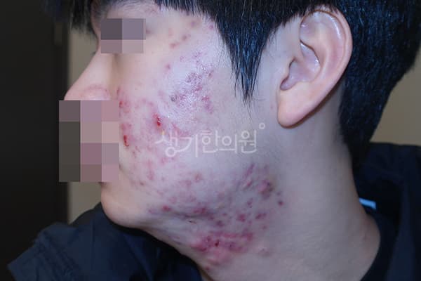 여드름 치료 전 사진 — 천안아산점, 치료 기간 6개월