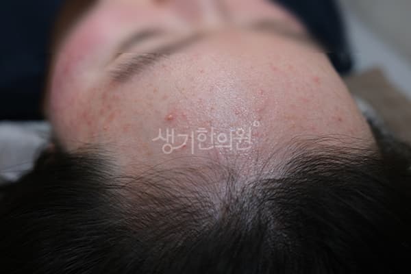 여드름 치료 전 사진 — 대전점, 치료 기간 10개월