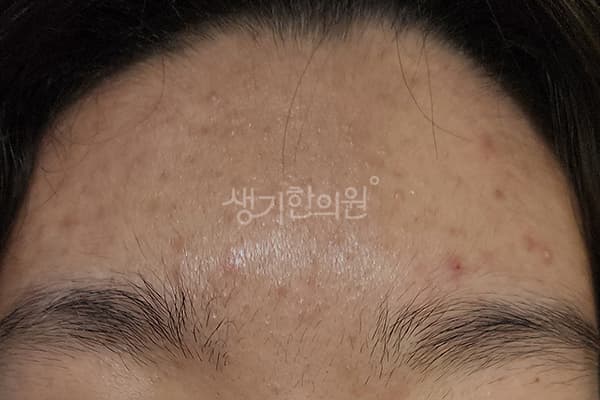 여드름 치료 전 사진 — 대전점, 치료 기간 6개월