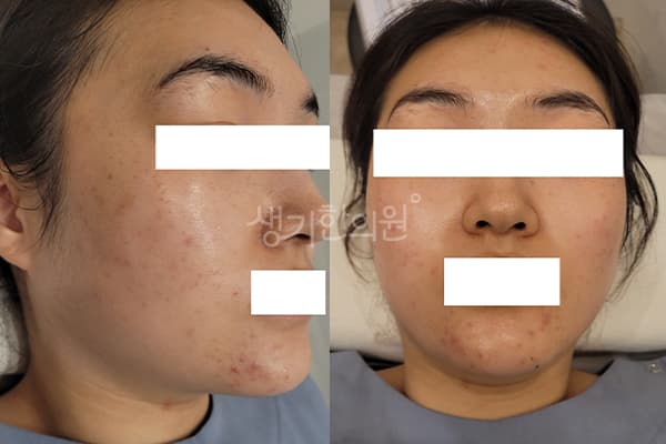여드름 치료 전 사진 — 마포공덕점, 치료 기간 6개월