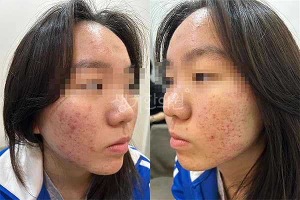 여드름 치료 전 사진 — 신도림점, 치료 기간 12개월