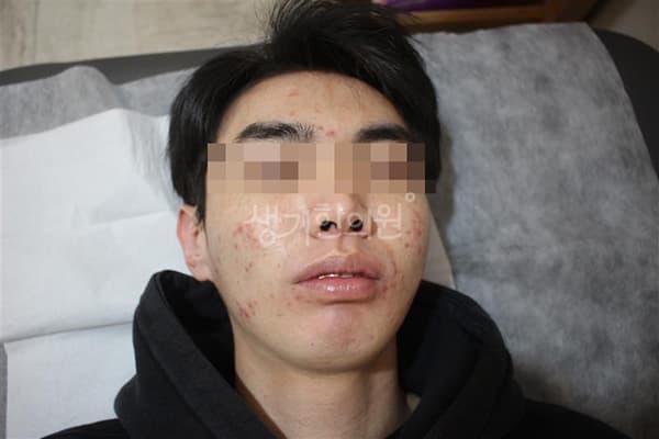 여드름 치료 전 사진 — 수원점, 치료 기간 5개월