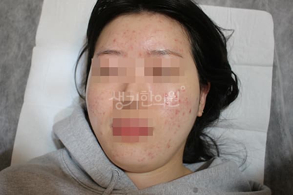 여드름 치료 전 사진 — 수원점, 치료 기간 9개월