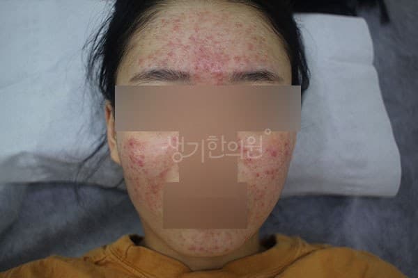 얼굴 전체에 번진 붉은 염증성 여드름과 홍조, 10대 여성 (치료 전, 2021.03)