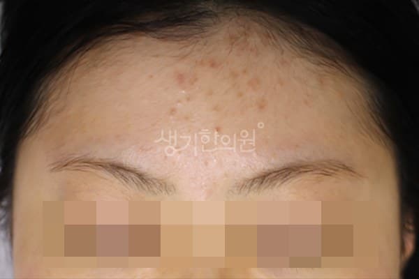 이마에 오돌토돌 올라온 좁쌀 여드름과 붉은 염증, 20대 여성 (치료 전, 2025.12)