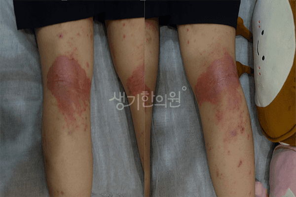 아토피 치료 전 사진 — 부천점, 치료 기간 5개월